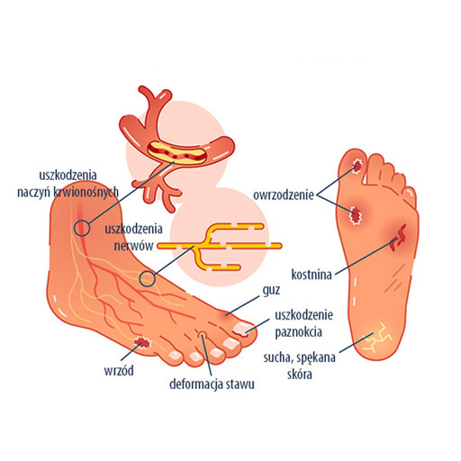 Grafika stopy cukrzycowej